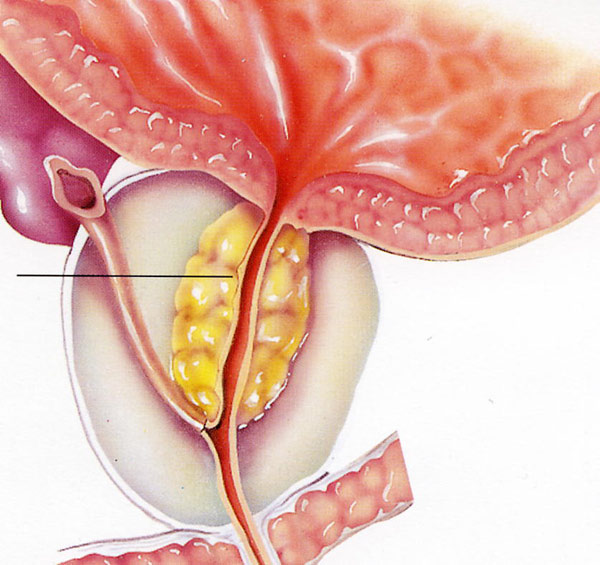 ipertrofia prostatica e fertilità remediu pentru tratamentul rapid al prostatitei